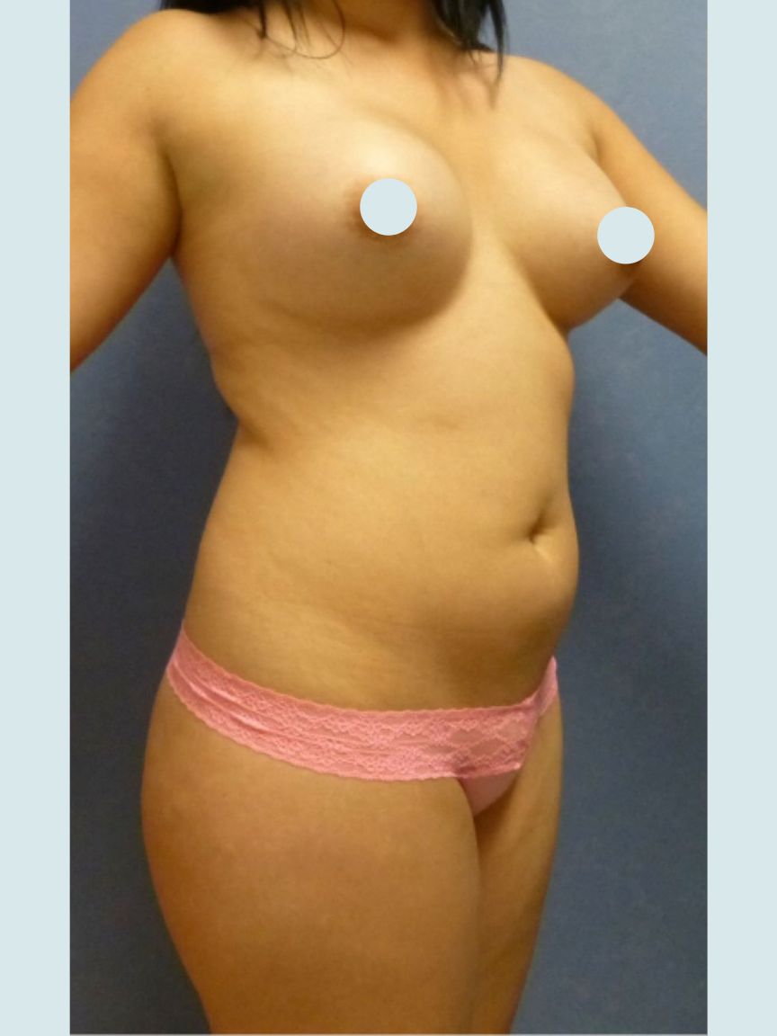 Liposuction