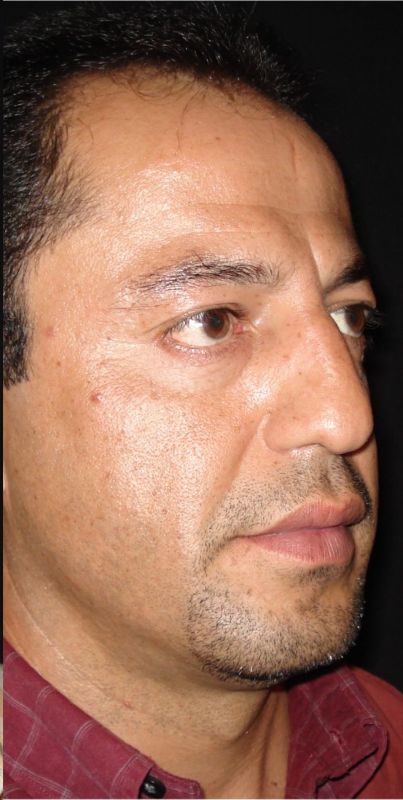 Rhinoplasty