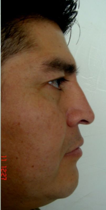 Rhinoplasty