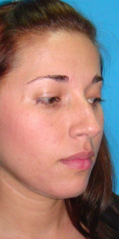 Rhinoplasty