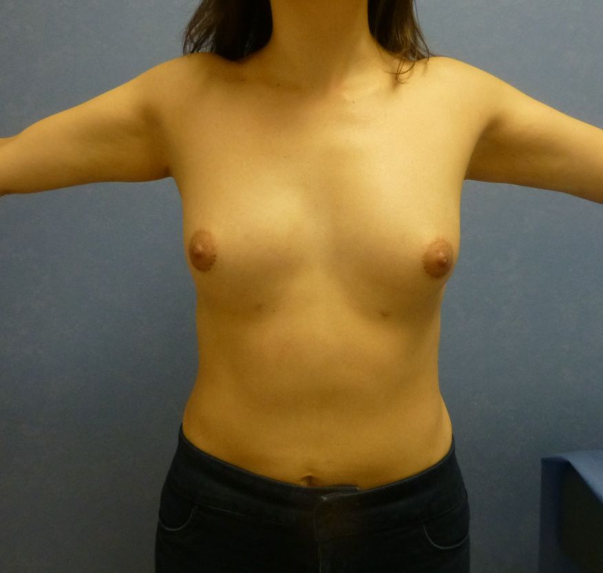 Breast Augmentation