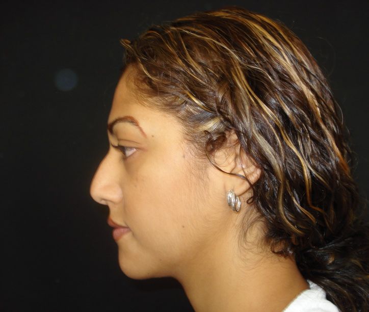 Rhinoplasty