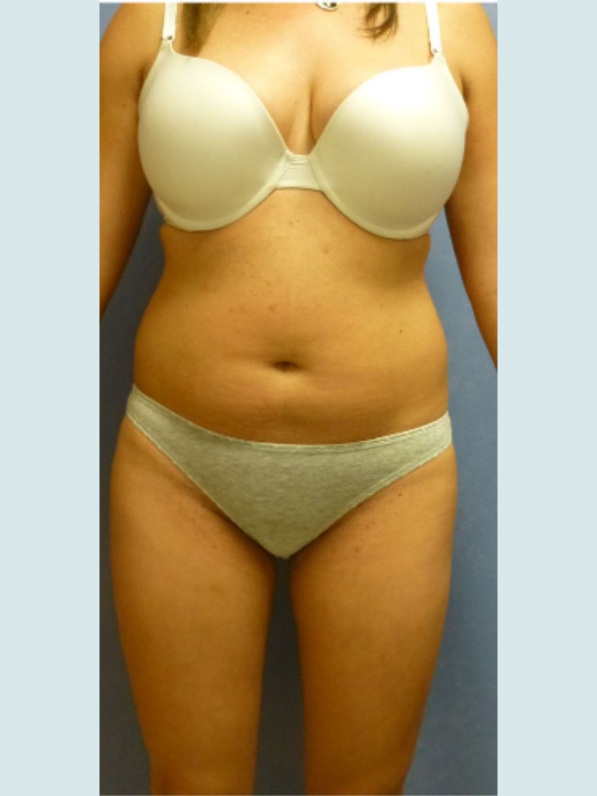 Liposuction