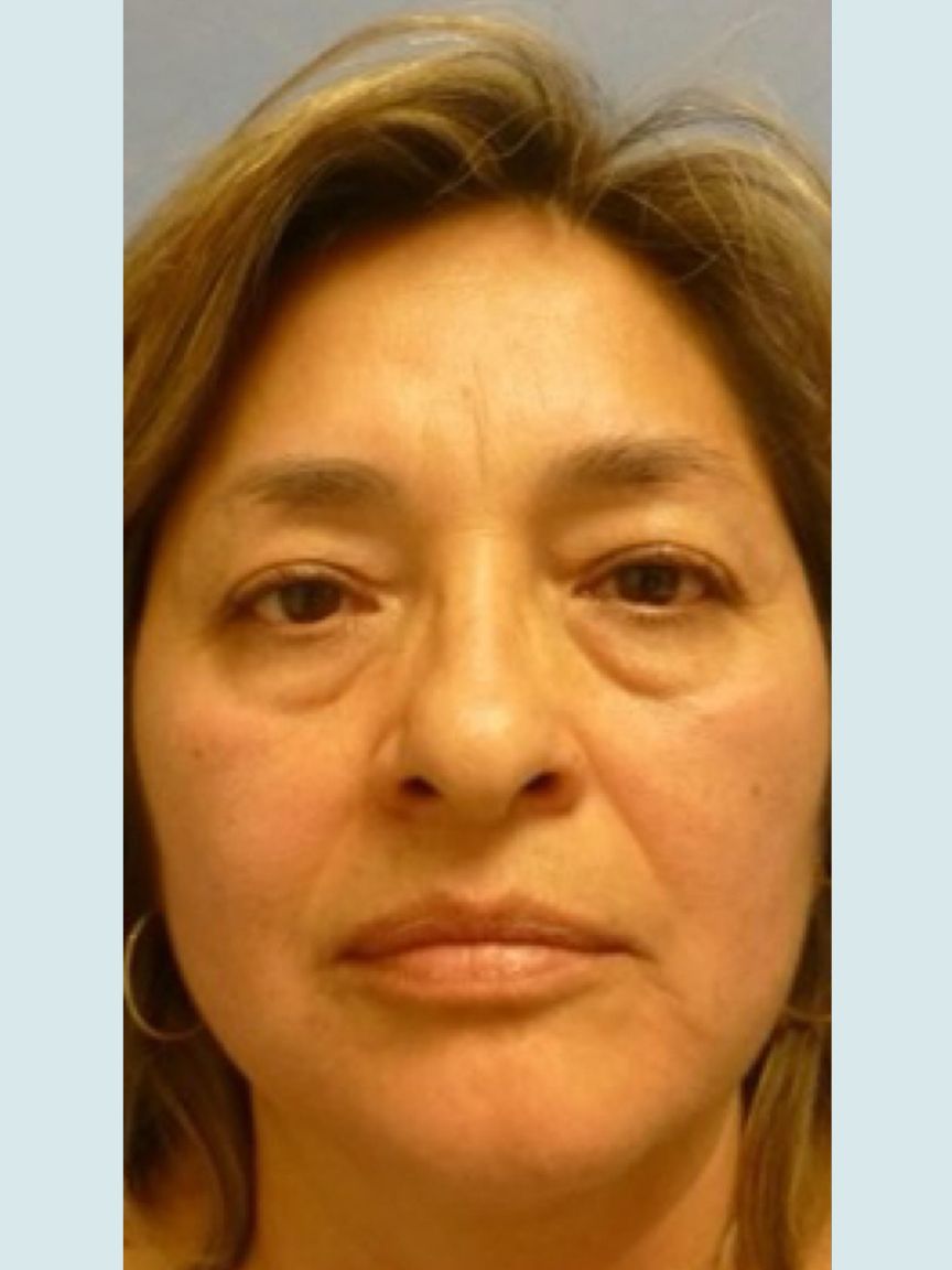 Facelift with Blepharoplasty