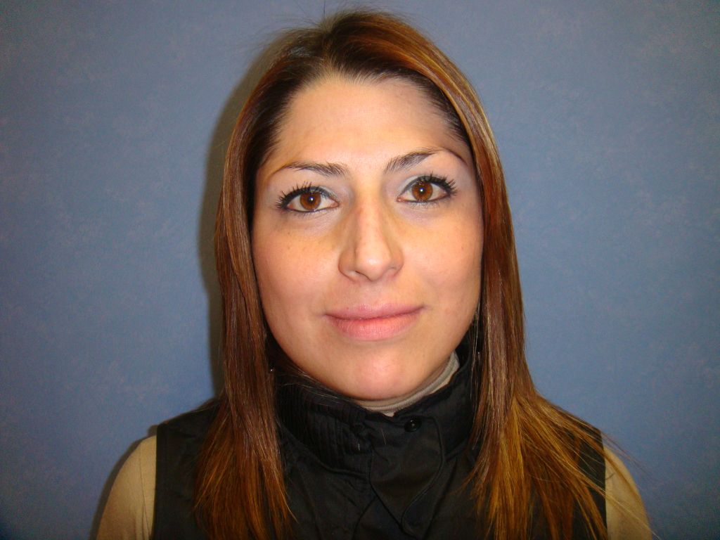 Rhinoplasty