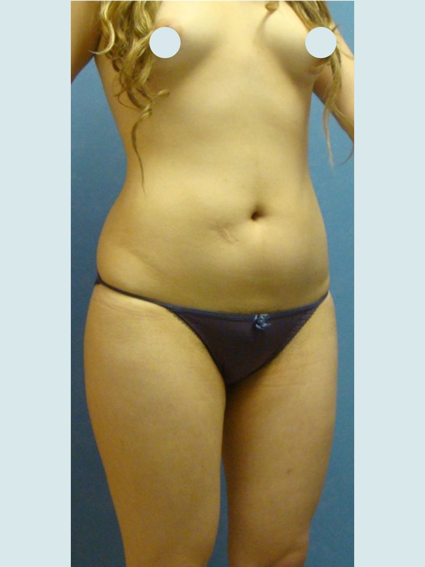 Liposuction w/ BBL