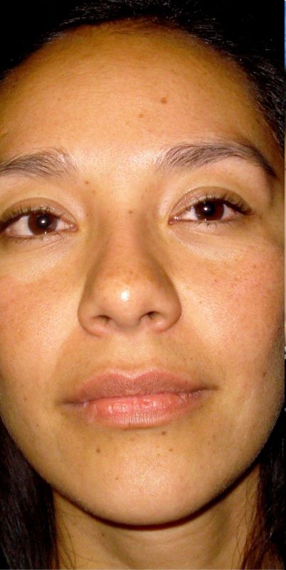 Rhinoplasty