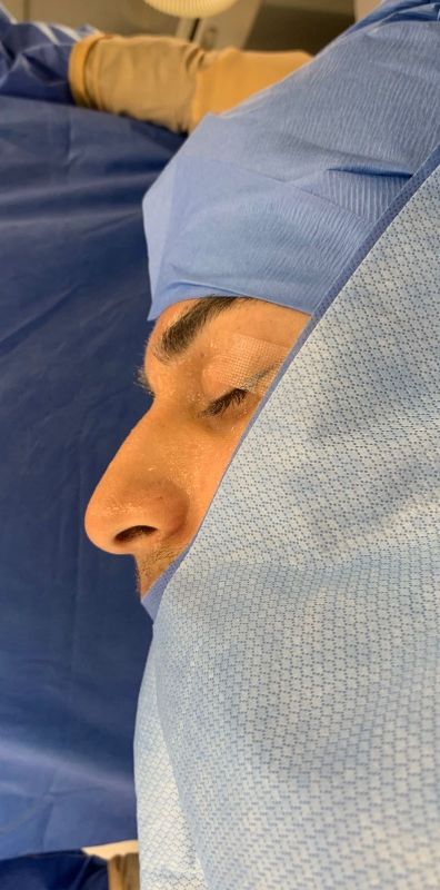 Rhinoplasty