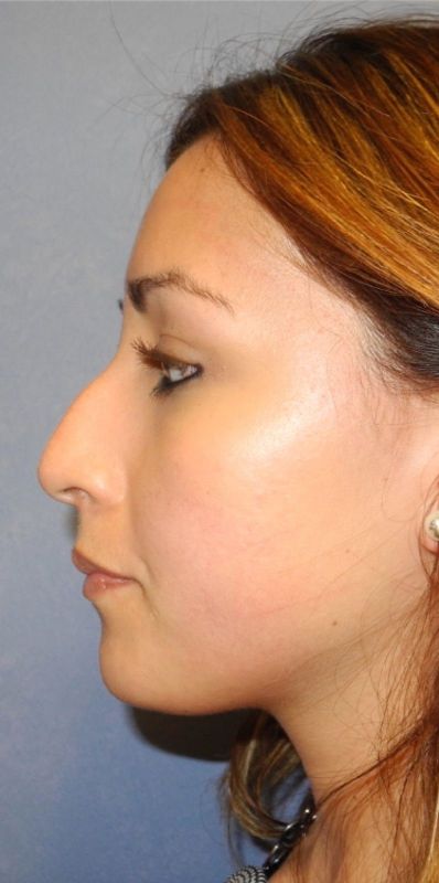 Rhinoplasty