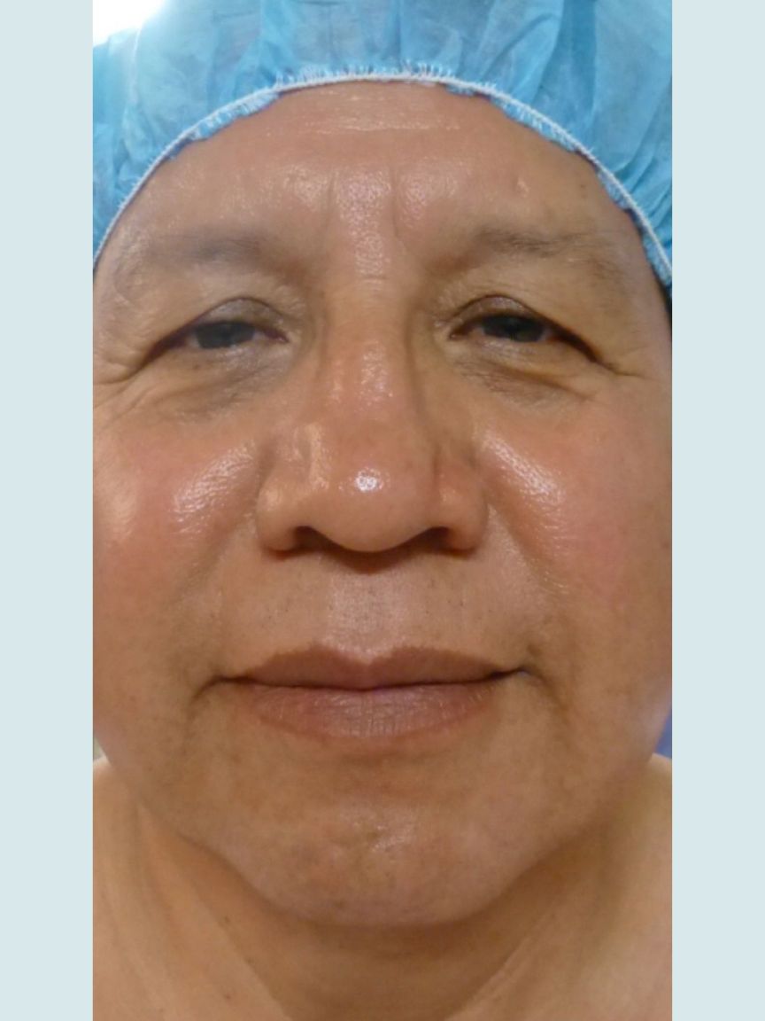 Facelift with Blepharoplasty