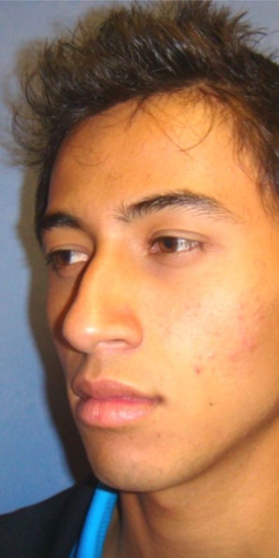 Rhinoplasty