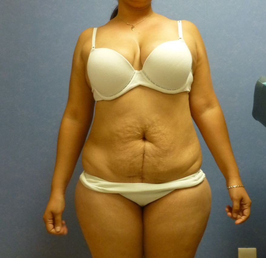 Tummy Tuck