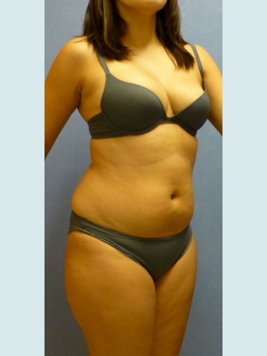 Liposuction