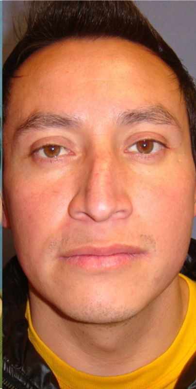 Rhinoplasty