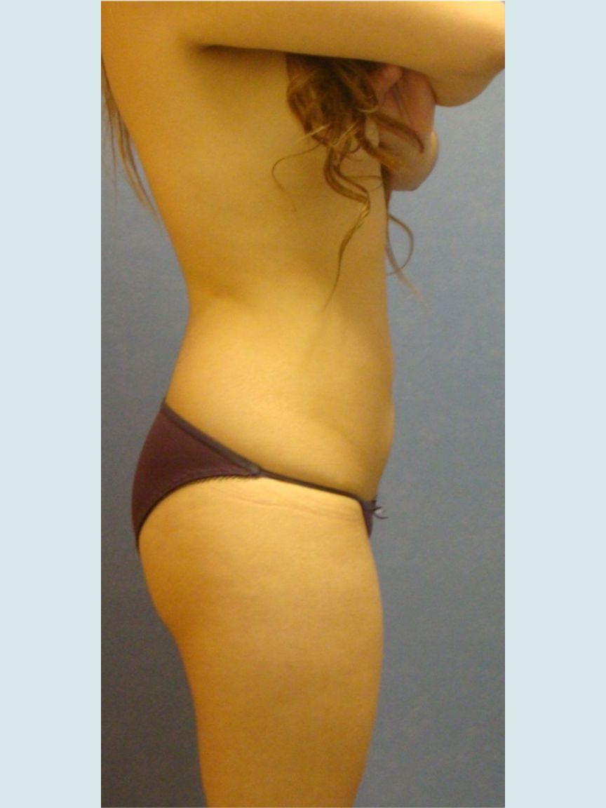 Liposuction w/ BBL