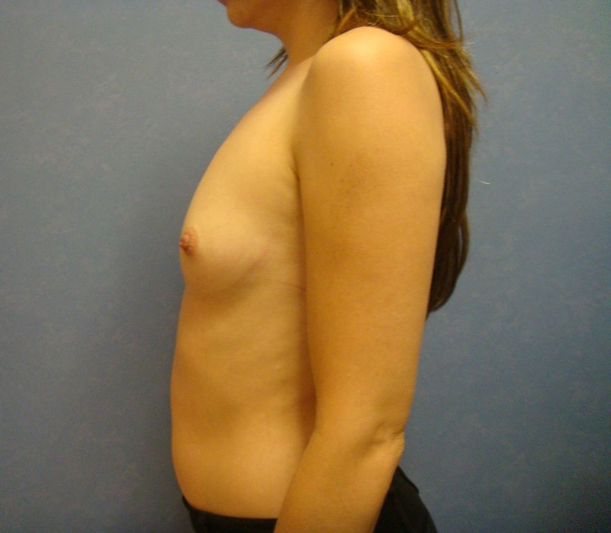 Breast Augmentation