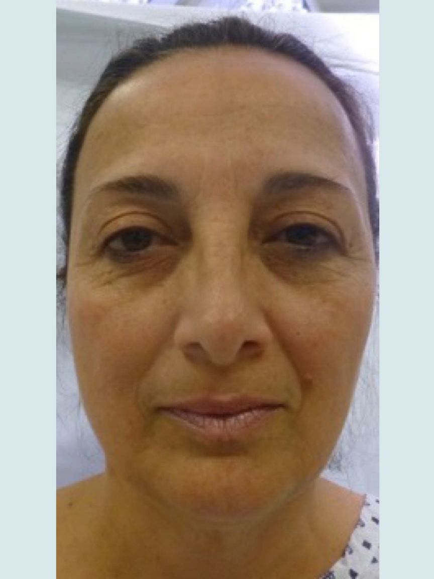 Facelift with Blepharoplasty