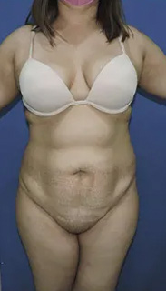 Tummy Tuck