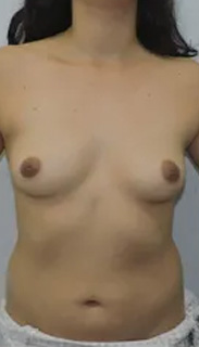 Breast Augmentation