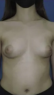 Breast Augmentation