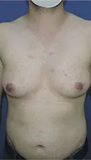 Mastectomy