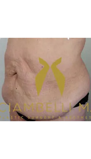 Tummy Tuck