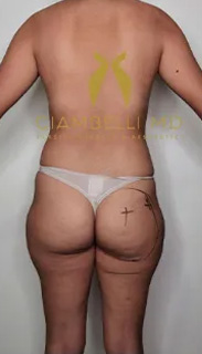 Brazilian Butt Lift