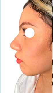 Rhinoplasty