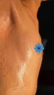 Breast Augmentation