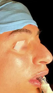Rhinoplasty