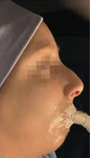 Rhinoplasty