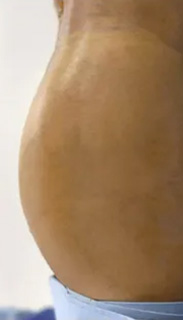 Brazilian Butt Lift