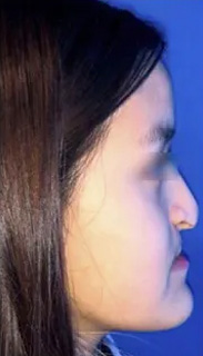 Rhinoplasty