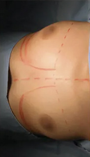 Breast Augmentation