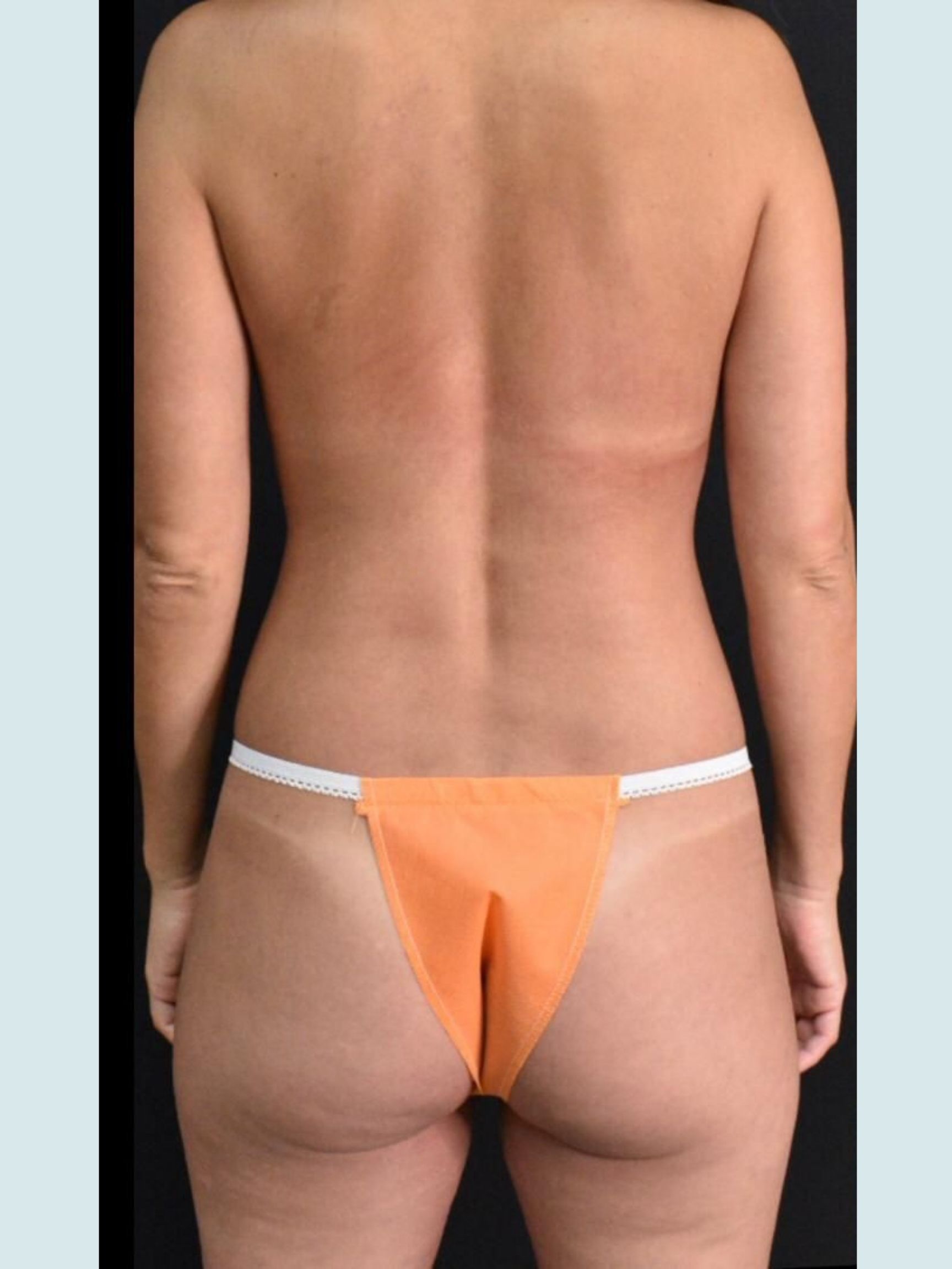 Brazilian Butt Lift